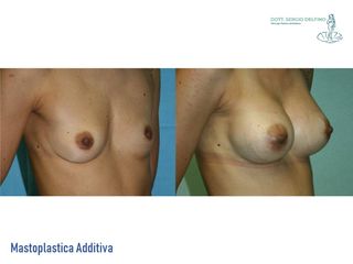 Mastoplastica additiva prima e dopo