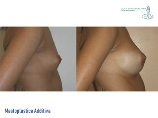 Mastoplastica additiva prima e dopo