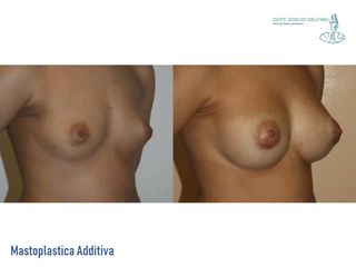 Mastoplastica additiva prima e dopo