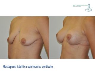Mastopessi Additiva prima e dopo