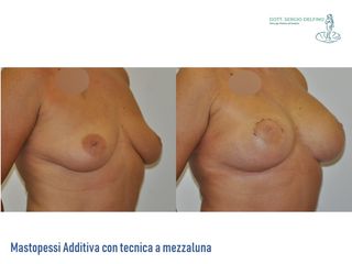 Mastopessi prima e dopo