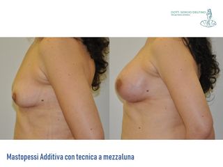 Mastopessi prima e dopo