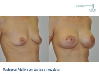 Mastopessi prima e dopo