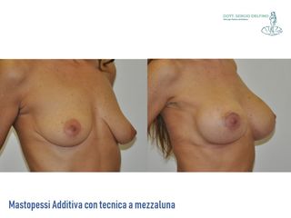 Mastopessi prima e dopo