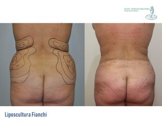 Liposcultura prima e dopo