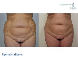 Liposcultura prima e dopo