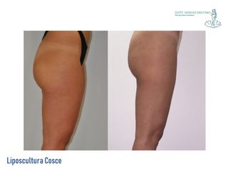 Liposcultura prima e dopo