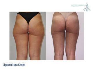 Liposcultura prima e dopo