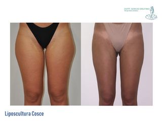 Liposcultura prima e dopo
