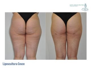 Liposcultura prima e dopo