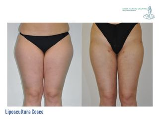 Liposcultura prima e dopo