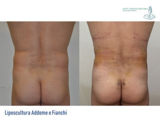 Liposcultura prima e dopo