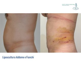 Liposcultura prima e dopo