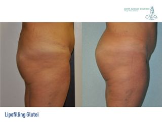 Lipofilling prima e dopo
