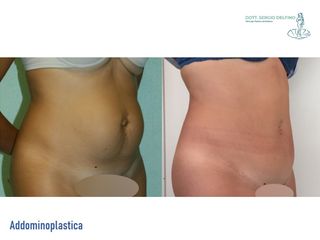 Addominoplastica prima e dopo