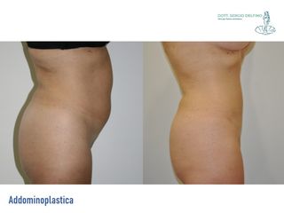 Addominoplastica prima e dopo