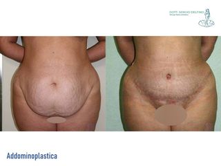 Addominoplastica prima e dopo