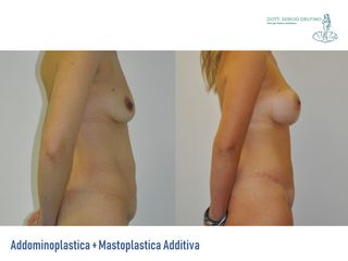 Addominoplastica e mastoplastica