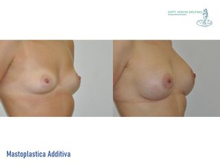 Mastoplastica additiva - Dott. Sergio Delfino