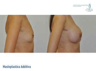 Mastoplastica additiva - Dott. Sergio Delfino