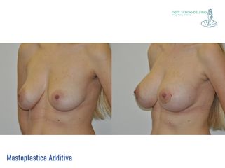 Mastoplastica additiva - Dott. Sergio Delfino