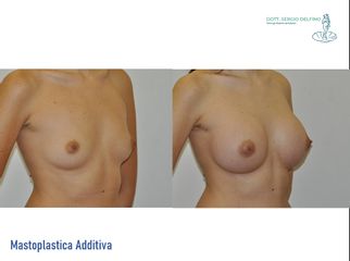 Mastoplastica additiva - Dott. Sergio Delfino
