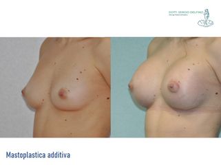 Mastoplastica additiva - Dott. Sergio Delfino