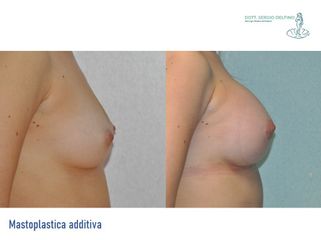 Mastoplastica additiva - Dott. Sergio Delfino