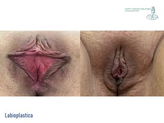 Labioplastica - Dott. Sergio Delfino