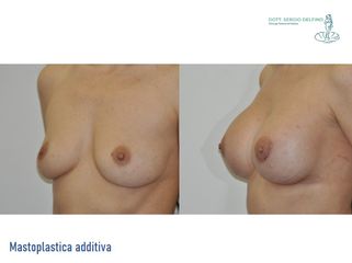Mastoplastica additiva - Dott. Sergio Delfino