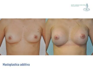 Mastoplastica additiva - Dott. Sergio Delfino