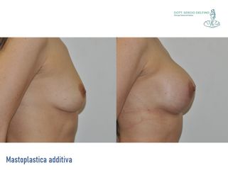 Mastoplastica additiva - Dott. Sergio Delfino