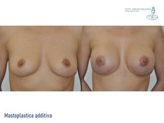 Mastoplastica additiva - Dott. Cristiano BiagiDott. Sergio Delfino