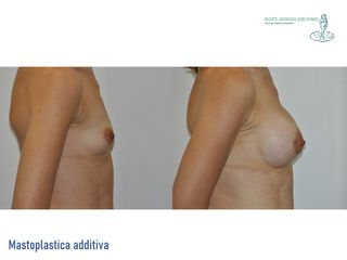 Mastoplastica additiva - Dott. Sergio Delfino