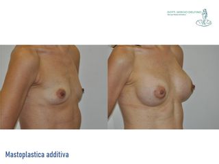 Mastoplastica additiva - Dott. Sergio Delfino