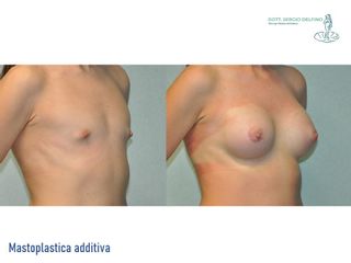 Mastoplastica additiva - Dott. Sergio Delfino