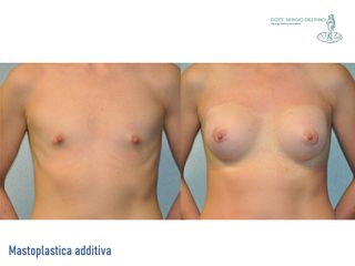 Mastoplastica additiva - Dott. Sergio Delfino