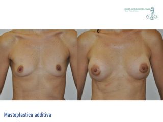 Mastoplastica additiva - Dott. Sergio Delfino