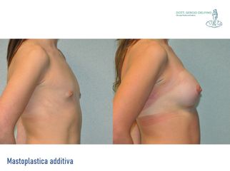 Mastoplastica additiva - Dott. Sergio Delfino