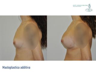 Mastoplastica additiva - Dott. Sergio Delfino