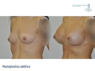 Mastoplastica additiva - Dott. Sergio Delfino
