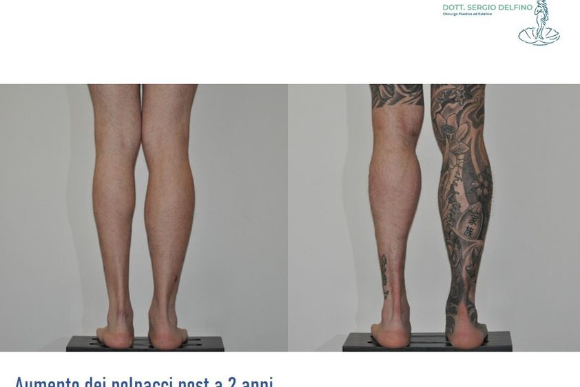 Aumento polpacci prima e dopo - 838737