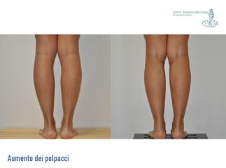 Aumento polpacci - Dott. Sergio Delfino