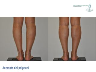 Aumento polpacci - Dott. Sergio Delfino