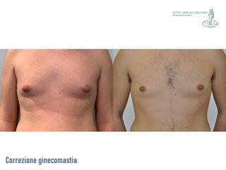 Ginecomastia - Dott. Sergio Delfino