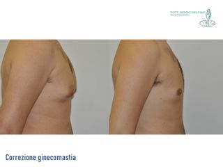 Ginecomastia - Dott. Sergio Delfino