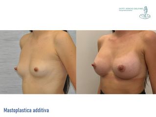 Mastoplastica additiva - Dott. Sergio Delfino