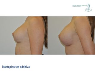 Mastoplastica additiva - Dott. Sergio Delfino