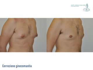 Ginecomastia - Dott. Sergio Delfino