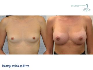 Mastoplastica additiva - Dott. Sergio Delfino